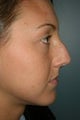 Rhinoplasty