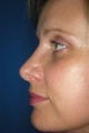 Rhinoplasty