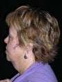 Face and neck lift