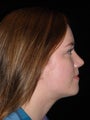 Wide excision and flap closure for melanoma
