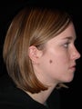 Wide excision and flap closure for melanoma