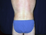 Back Lift