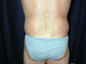 Back Lift