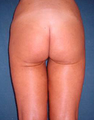Butt Lift