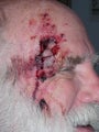 Repair of complex facial laceration