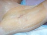 Removal of axillary sweat glands for axillary hyperhidrosis