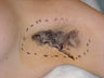 Removal of axillary sweat glands for axillary hyperhidrosis