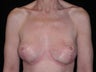 Breast lift (mastopexy)