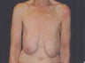 Breast lift (mastopexy)