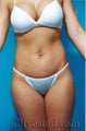 Tummy Tuck