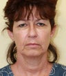 Face and Necklift, Eyelids, Temporal Browlift