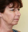 Face and Necklift, Eyelids, Temporal Browlift