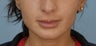 Lip Augmentation with Restylane