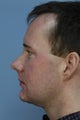 Chin Augmentation
