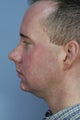 Chin Augmentation