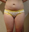 Liposuction