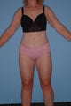 Lower Body Lift with Tumescent Liposuction