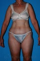 Lower Body Lift with Tumescent Liposuction