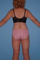 Lower Body Lift and Tumescent Liposuction