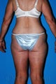 Lower Body Lift and Tumescent Liposuction
