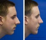 Rhinoplasty