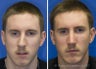 Rhinoplasty