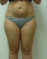 Liposuction