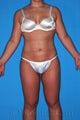 Liposuction