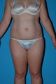 Liposuction