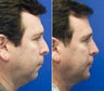 Rhinoplasty, Sliding Genioplasty, Neck liposuction