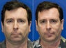 Rhinoplasty, Sliding Genioplasty, Neck liposuction