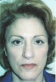 Facelift