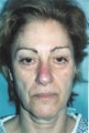 Facelift