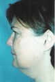 Facelift