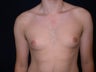 Gynecomastia Reduction Surgery
