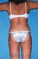 Liposuction