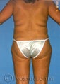 Liposuction