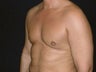 Male Breast Reduction