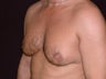 Male Breast Reduction