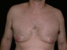 Gynecomastia Reduction Surgery