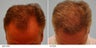 Hair Transplant 