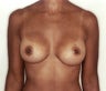 Breast Augmentation