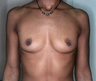Breast Augmentation
