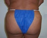 Brazilian Butt Lift
