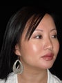 Lip augmentation with Juvederm