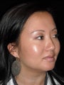 Lip augmentation with Juvederm