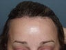 Browlift/forehead reduction at 2 weeks