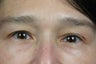 Restylane to Tear Trough