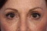 Restylane