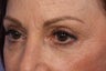 Restylane 